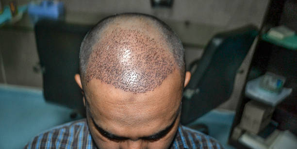 HAIR TRANSPLANT