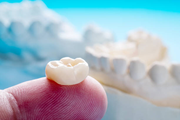 dental crowns in St. George Utah dental crowns in St. George Utah
